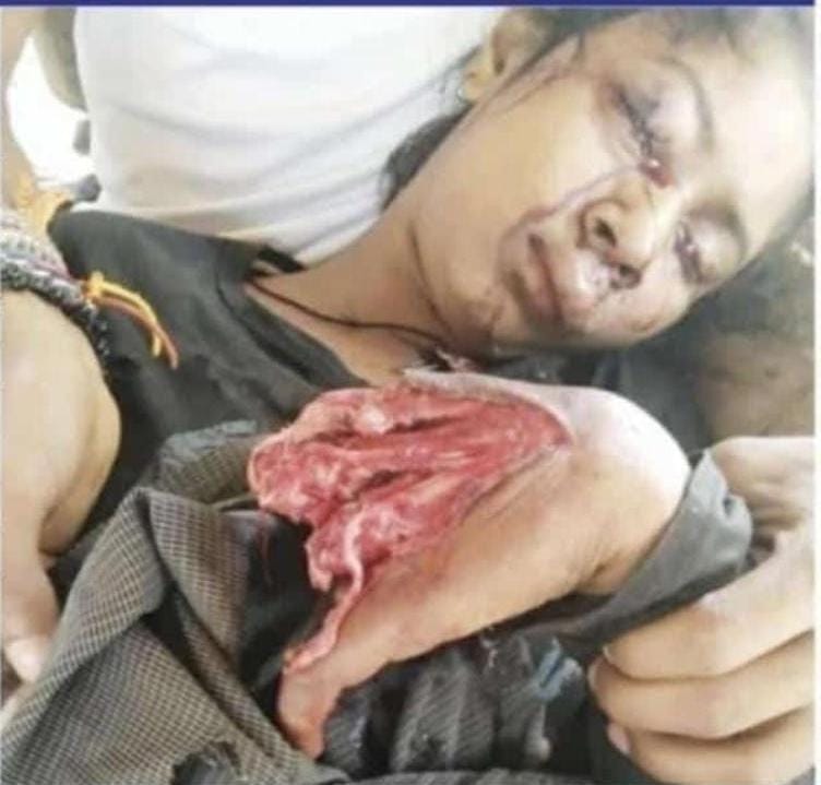 गेम खेल पड़ा भारी,फटा मोबाइल उड़े पंजे के चीथड़े, गेम खेलते समय हुआ विस्फोट